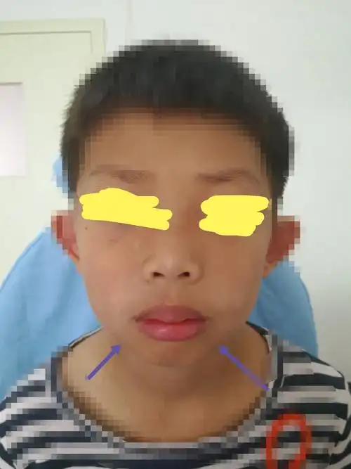 腺样体面容已经形成,八岁半的孩子 - 好大夫在线