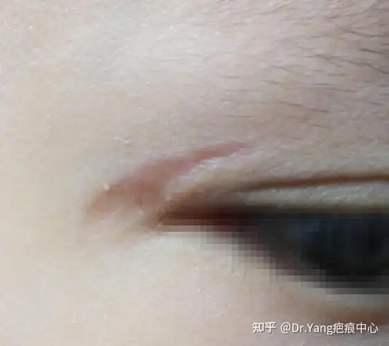 颜面部伤口尽量做美容缝合,不要相信一抹就好的"神药".