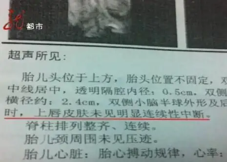 哈尔滨维多利亚妇产医院产前检查胎儿正常出生却唇裂