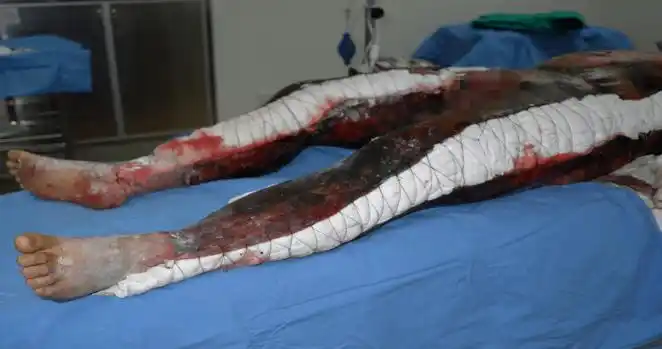 震惊被50万伏的高压电击穿小伙浑身焦黑肿胀休克超29小时