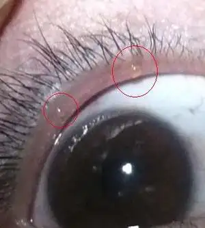 晚上回来用镜子一看眼睛上眼皮下面边缘处有2个类似透明的黄色小疙瘩