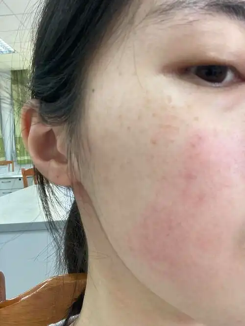 为什么俺的脸会痒而且红块越来越大了00