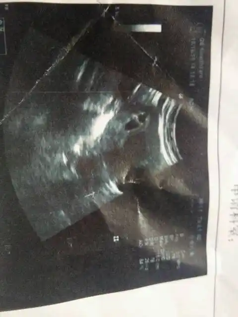 生了男孩当时42天孕囊