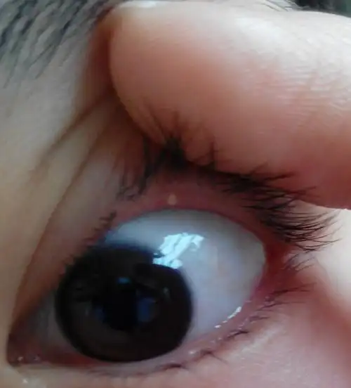 今天发现眼睛里长了个这样的小粒.以前也在同样的地方长过,没管它