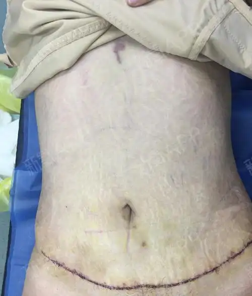 腹壁成形术#自从生了宝宝之后肚子上的赘肉就一直没有_圈子-新氧美容