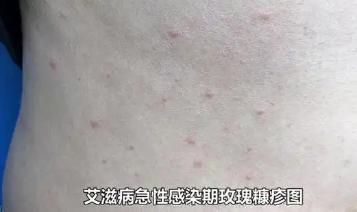 临床上一般将艾滋病分为潜伏期,急性感染期,无症状感染期,艾滋病相关