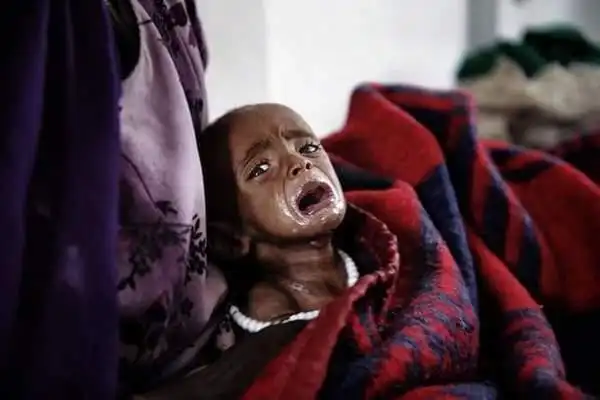 被饿得骨瘦如柴的非洲儿童让人心酸又心痛