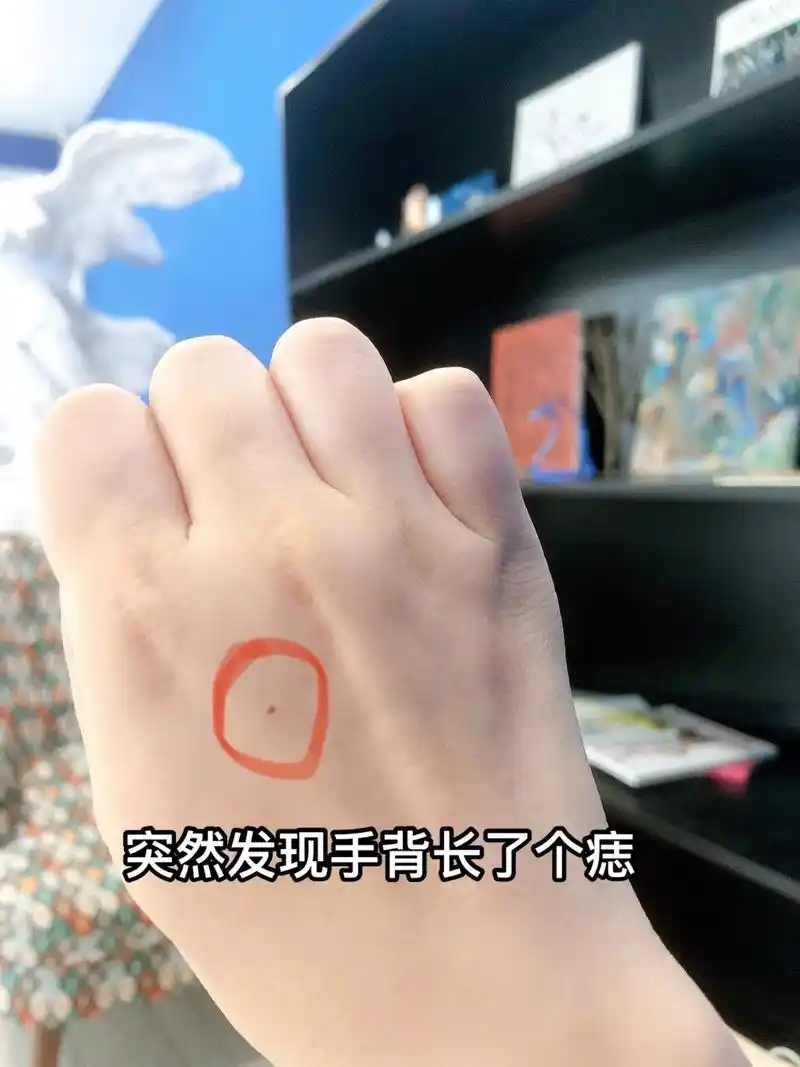 突然发现手背长了个痣,翻视频破案