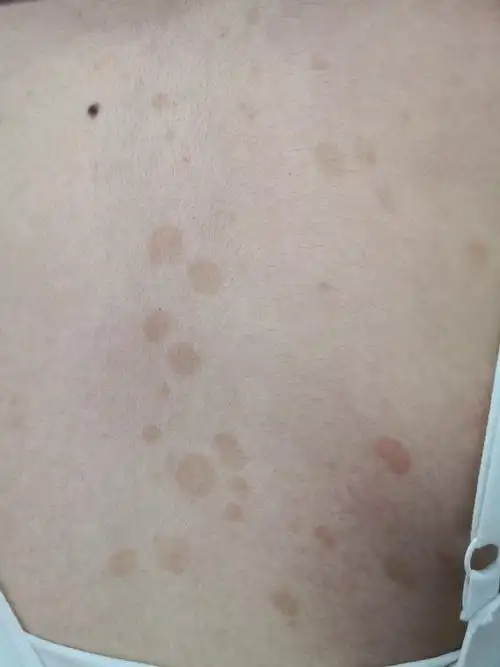 汗斑##真菌##解决皮肤问题专注皮肤美容