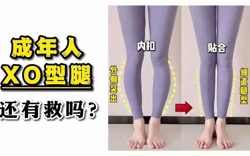 成年人的"xo型腿"还有救吗?