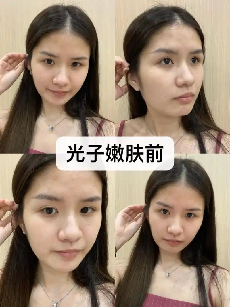 超级开心这次抽中嘉宝蓝娜的dpl光子嫩肤体验官!