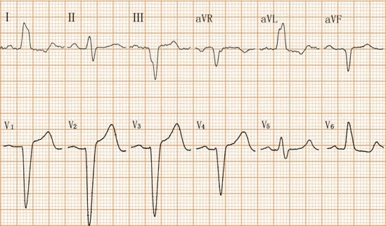 完全性左束支传导阻滞心电图