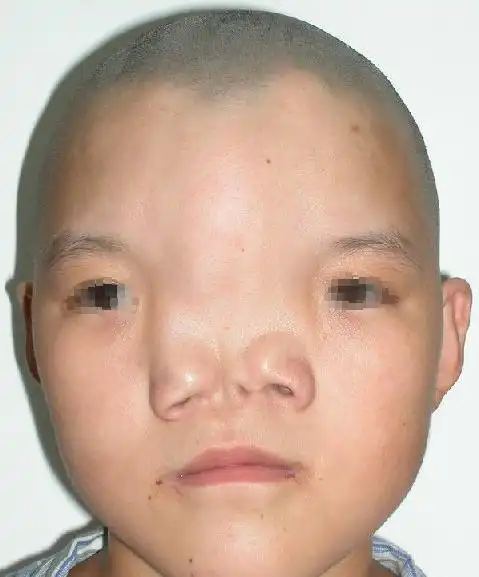 眶距增宽症的临床表现和手术方法_颅脑先天畸形_颅脑先天畸形相关疾病