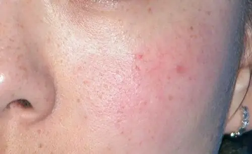 肌肤缺水当肌肤极度缺水时会出现短暂的刺痛感,主要是因为在敷面膜之