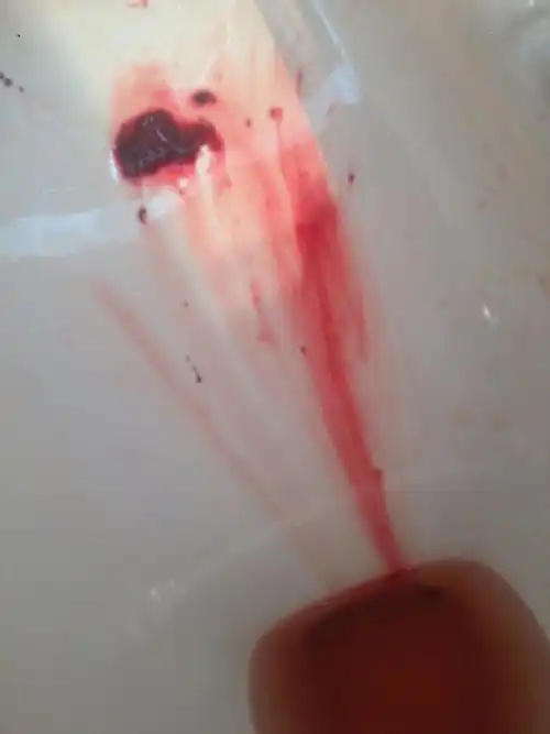 什么会有血快?是不是有身体有有问题?