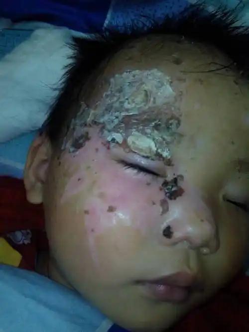 宝宝被猪油烫伤了,这样以后会不会留疤痕,眉毛还会长吗