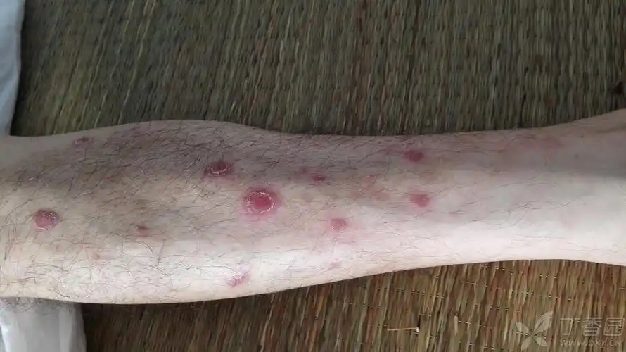 病例讨论,梅毒可以诊断么? - 皮肤与性传播疾病讨论版 -丁香园论坛