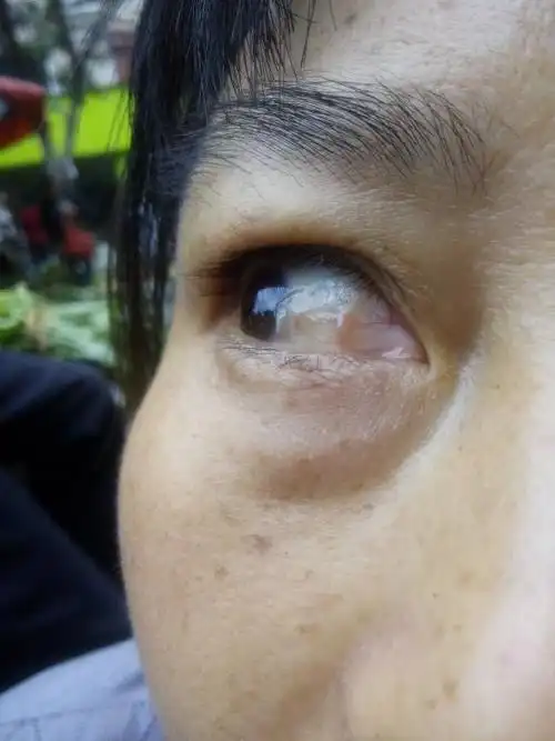 眼球有息肉一类的东西,血丝,如何处理?有什么药物可以治疗?谢谢