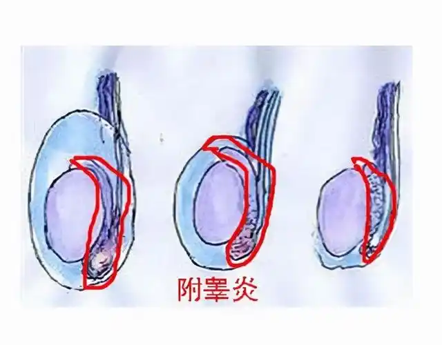 细菌或者真菌感染引起的炎症性疾病,其主要表现便是阴囊肿胀和疼痛
