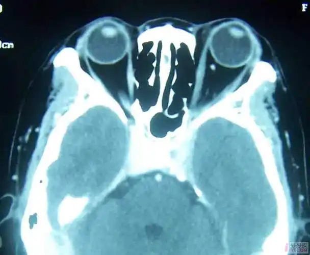 原创一眼球突出病人