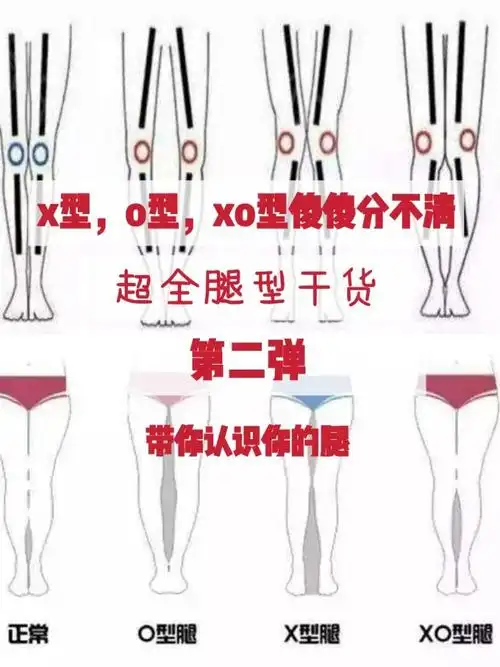 97判断腿型第二弹97x型腿,o型腿,xo型腿你还傻傻_圈子-新氧美容