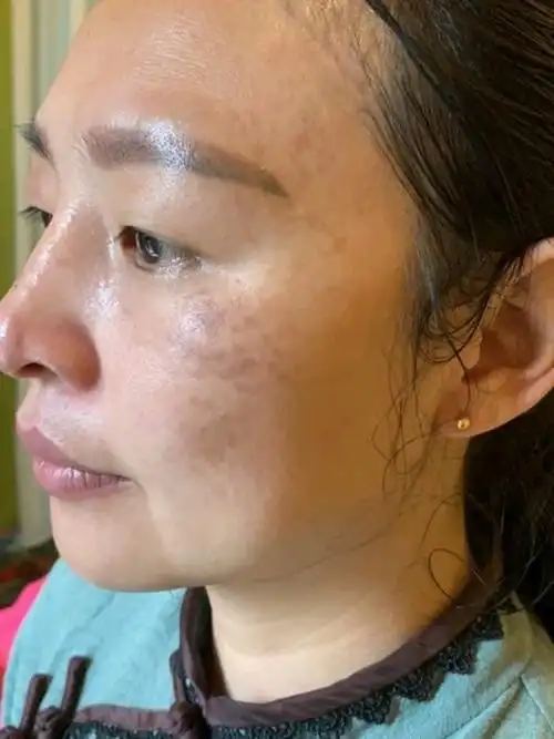 老顾客介绍过来的真皮斑,期待她的脱变吧.