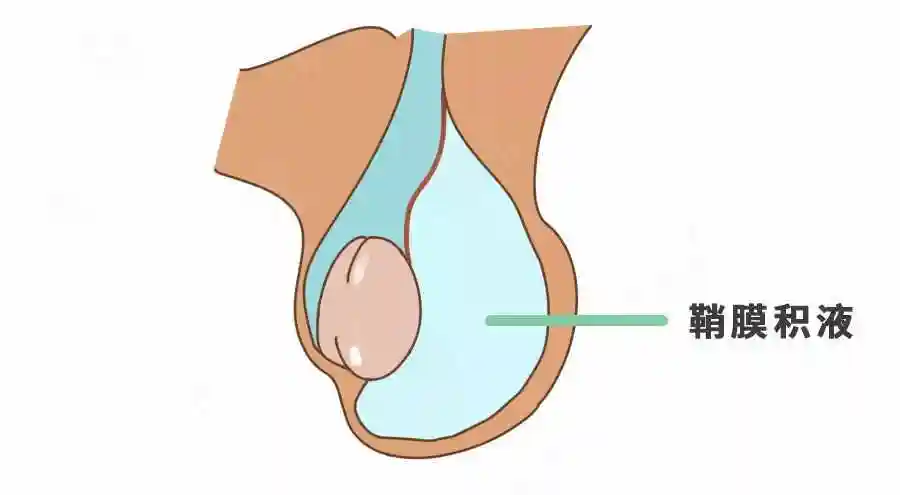 睾丸一个大一个小是怎么回事一个睾丸特别大一个特别小