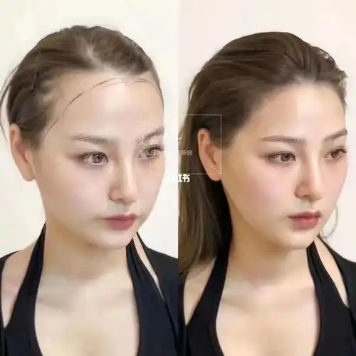 发际线调整完成73即刻对比