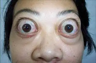 如果感觉眼睛向外突,必须到正规医院做眼球突出度检查,才能准确了解