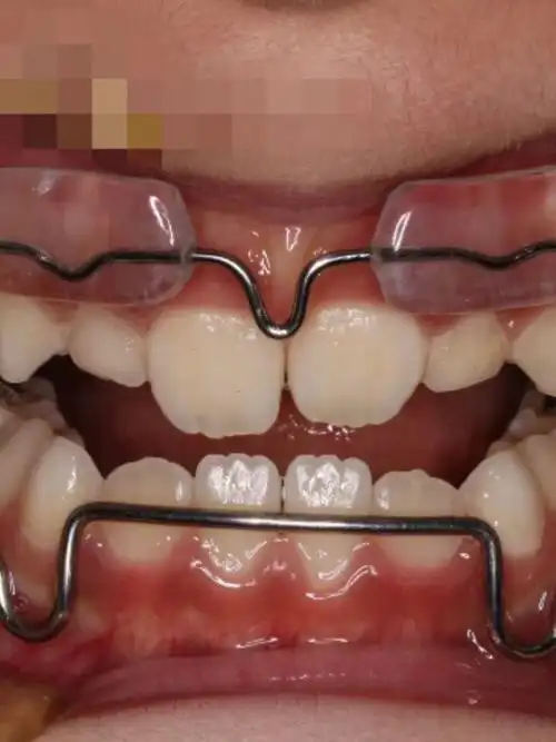 781578157岁半男孩儿,设计使用的改良frankel iii功能矫正器