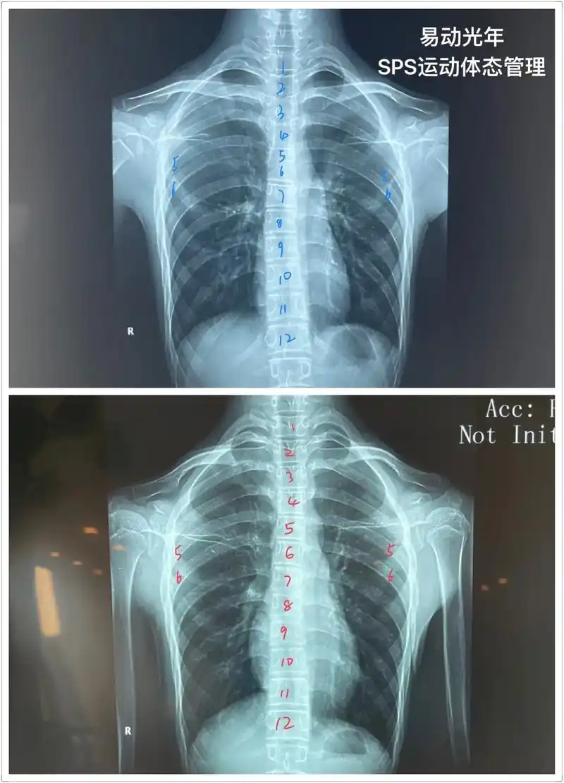 橘子同学33天sps运动对比.1,第5,6胸椎及第5,6肋骨 - 抖音
