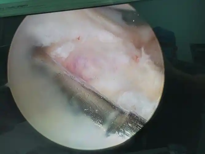 关节镜下半月板囊肿清理一例