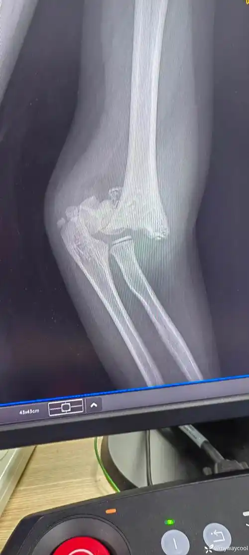 新年第一例肱骨髁上骨折