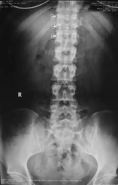 治疗腰椎间盘突出症的新技术介绍--微创低温等离子射
