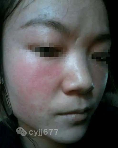 激素脸排毒是什么样子的?一篇文章搞懂!_皮肤_治疗_化妆品