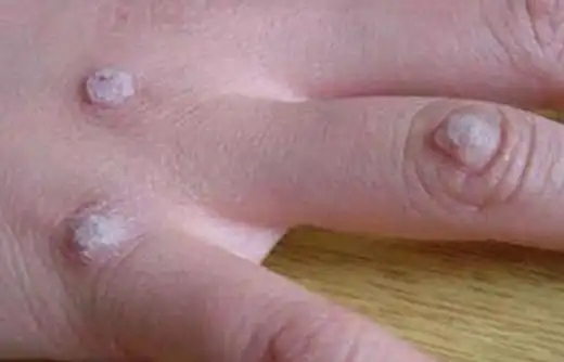 的皮肤会出现细长柔软的疣状赘生物,一般有人乳头瘤病毒感染所引起