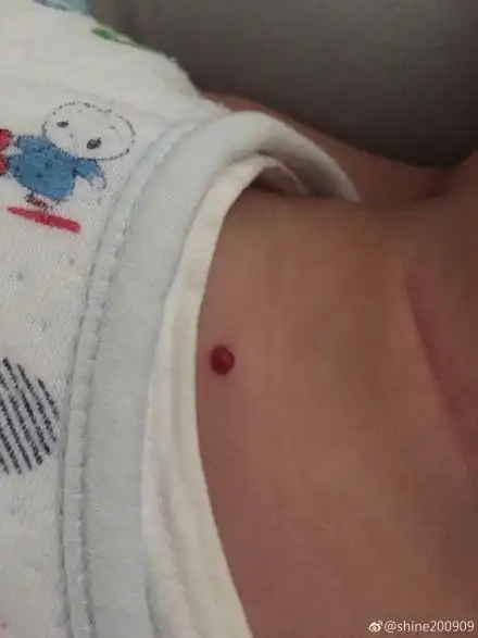 母婴研究院金牌专家,北京协和医院儿科主任医师):血管瘤有毛细血管痣