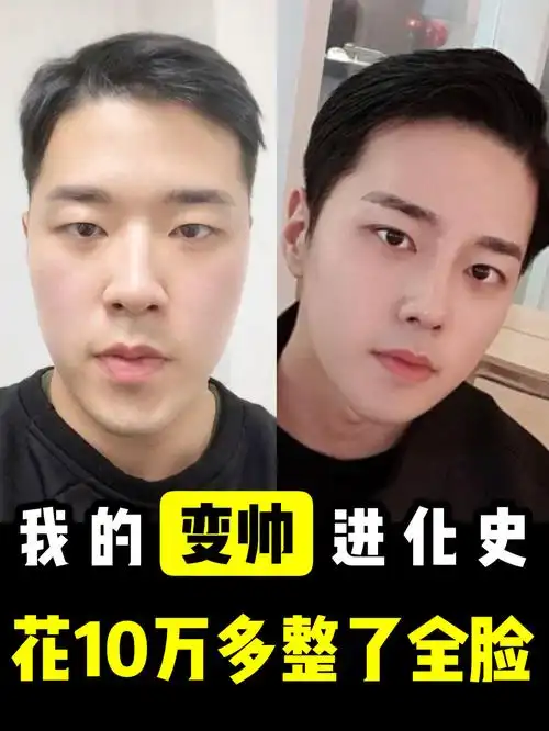 男生案例来了全脸综合打造2个月反馈