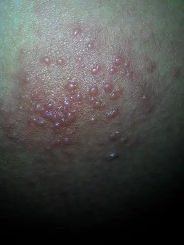 屁股上长泡,不痒,周围泛红,是什么病?