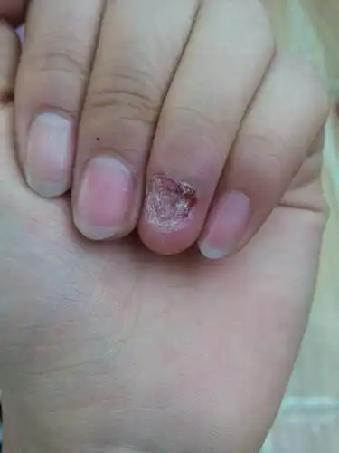 手指甲坏将近三年了一直这样,不知道还能不能好起来,期待专业人士的