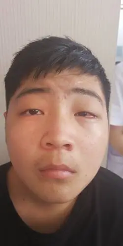 8.09斜视手术病人