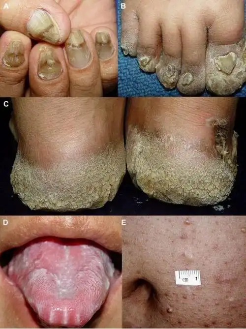 门诊经常有家长询问:宝贝指甲长得不好,是不是缺微量元素?