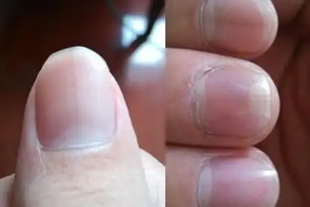 【图】大拇指手指甲凹凸不平原因是这样 这样可以使其消失不见
