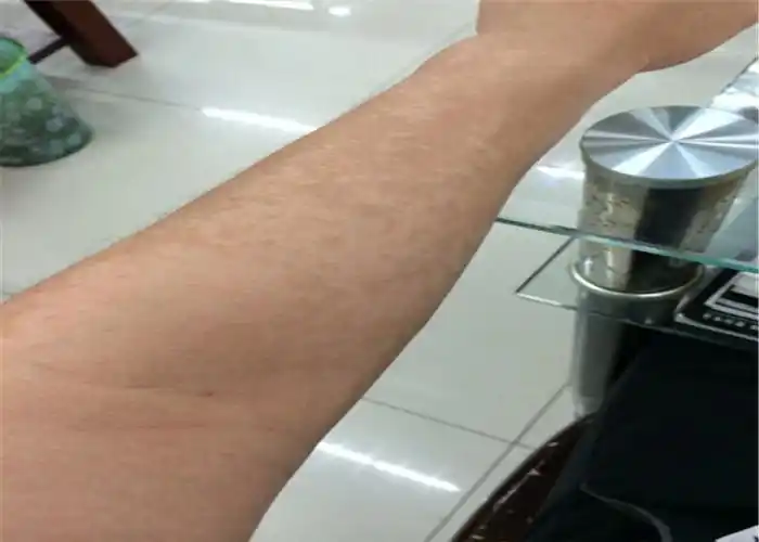 花斑癣成人皮肤病初期的症状图片