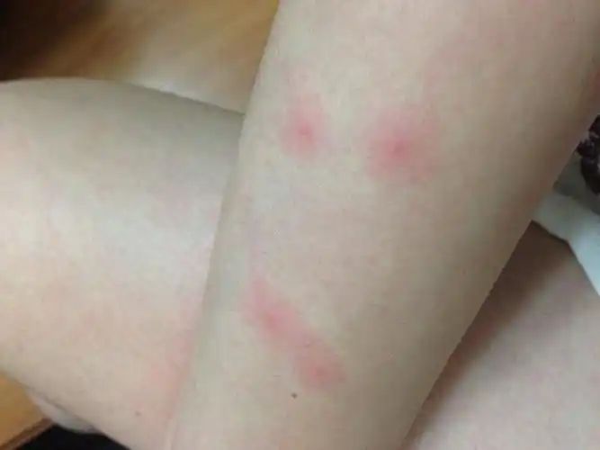 艾滋病初期症状皮肤