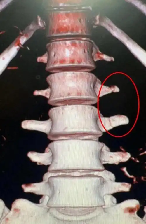 腰椎横突骨折严重吗?告知你不了解的骨折真相