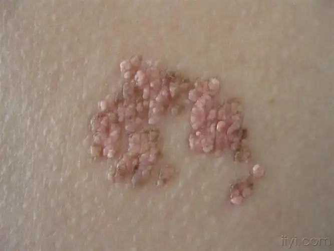 疣状痣 - 皮肤及性传播疾病讨论版 - 爱爱医医学论坛