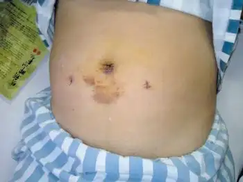 小儿腹股沟疝与鞘膜积液