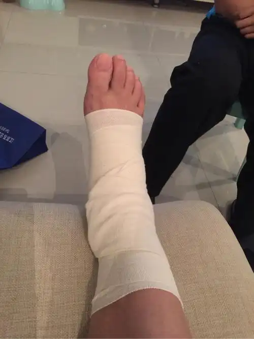 崴脚严重的话,还是要及早进行康复治疗,比如绑上弹力绷带!