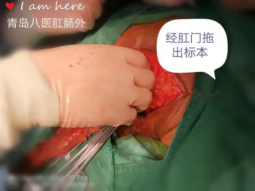 肛提肌外腹会阴联合切除术elape治疗低位进展期直肠癌